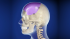 Краниофациальный имплант для реконструкции черепа человека